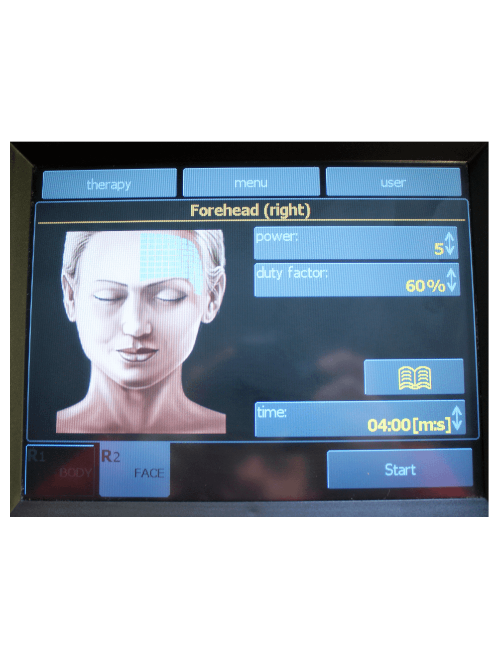 2011 BTL Exilis RF 除皺/帶 XP 2 和大手柄