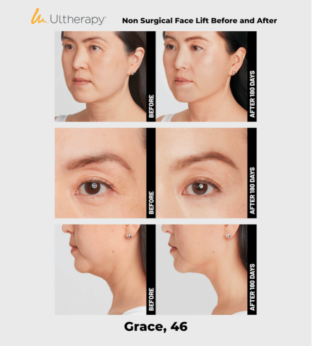 Ulthera Ultherapy DeepSee Transducer DS 7-4.5 (Purple) image 6