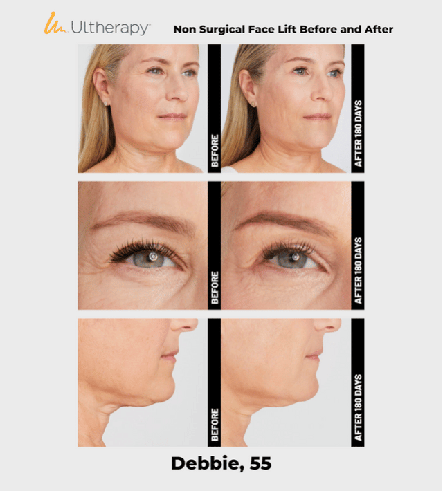 Ulthera Ultherapy DeepSee Transducer DS 10-1.5N (Orange Narrow) image 7