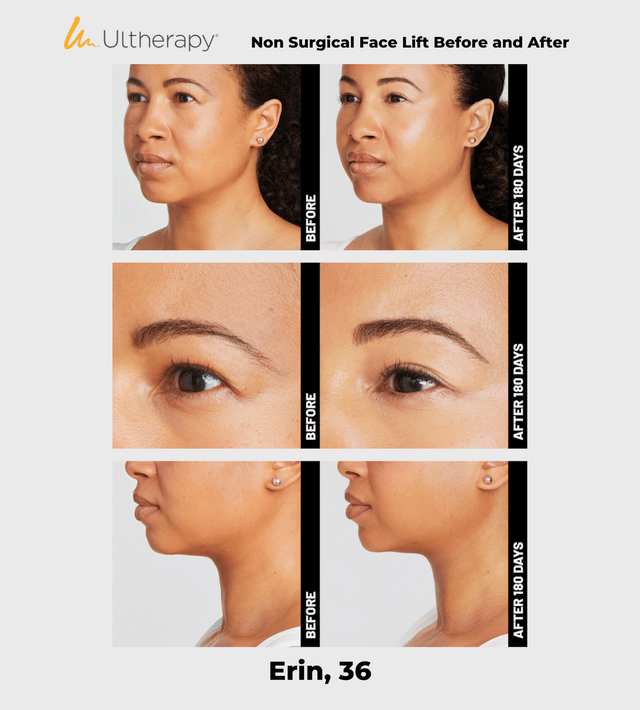 Ulthera Ultherapy DeepSee Transducer DS 10-1.5N (Orange Narrow) image 5